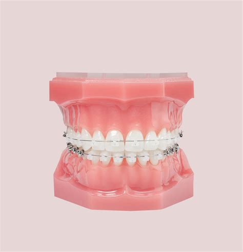 ceramic brackets with metal slot|clarity ceramic braces.